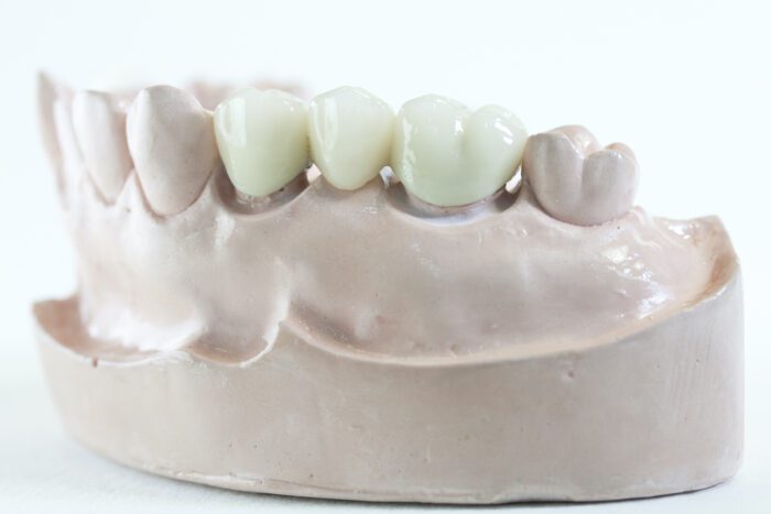 Dentists design partials to fit snugly in the patient's mouth, ensuring both comfort and functionality for your oral health.