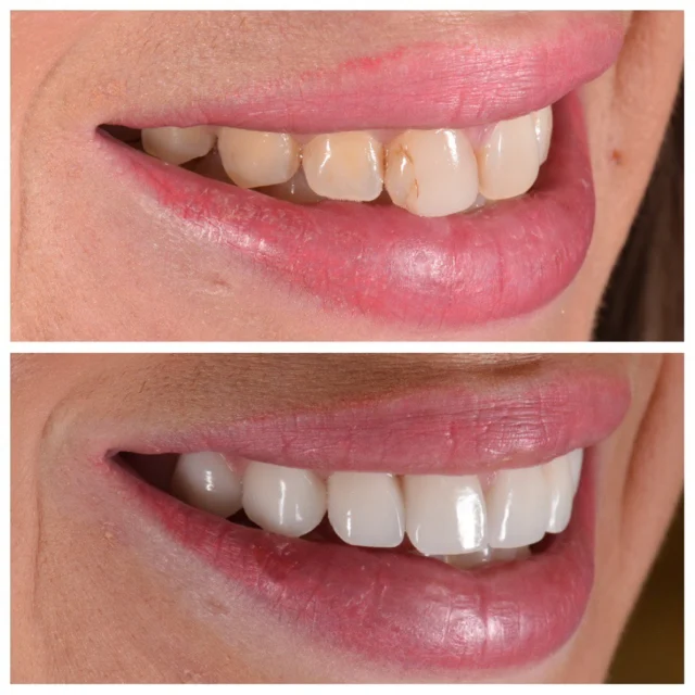 Ten veneers to restore proper function, symmetry, and structure ✨