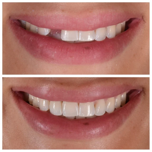 Beautiful natural result for this anterior implant case ✨ Implant cases take time and patience, especially when it’s a single tooth in the front of the smile! Luckily I had an understanding patient that worked with me until we got an outcome we both loved 😌